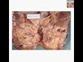 Histopathology Kidney--Transitional cell carcinoma