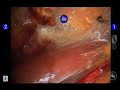 Robotic Nephrectomy --conducted by Dr. Domenico Savatta