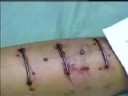 Implante transdermal.