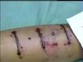 Implante transdermal.