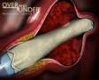Over and Under Pericardium Covered Stent