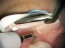 Furcaton Repair with LANAP protocol Furcaton Repair with LANAP protocol