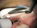 Furcaton Repair with LANAP protocol