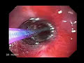 Esophageal Dilation due to a narrowing of the esophagus Esophageal Dilation due to a narrowing of the esophagus