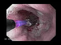 Esophageal Dilation due to a narrowing of the esophagus  Heart Diseases Antibiotics