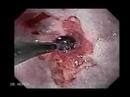 Esophageal Dilation due to a narrowing of the esophagus