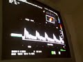 CAROTID ARTERIES ULTRA SOUND #3