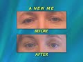 Maryland Eyelid Surgery Patient Results Gallery - Dr. Mark Richards