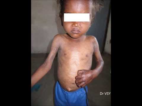 how to treat kwashiorkor and marasmus