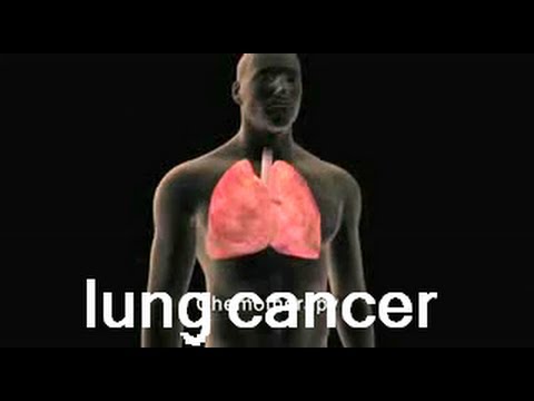 how to know lung cancer