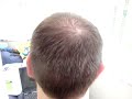 Nanogen video,PB hairloss forum,