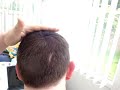 Nanogen video,PB hairloss forum,