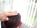 Nanogen video,PB hairloss forum,