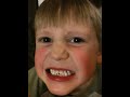 Zack looses his first tooth