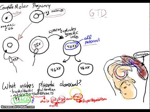 how to treat svt in pregnancy