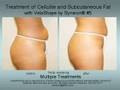 LipoLift™