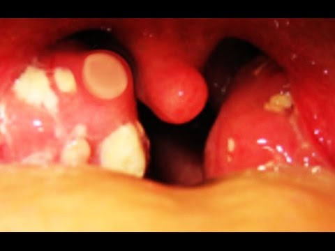 how to eliminate tonsil stones