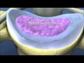 Bases anatomiques et traitement chirurgical de l'hernie discale lombaire