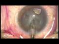 Intralenticular Foreing Body