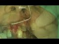 Dental Implant Video preview 03