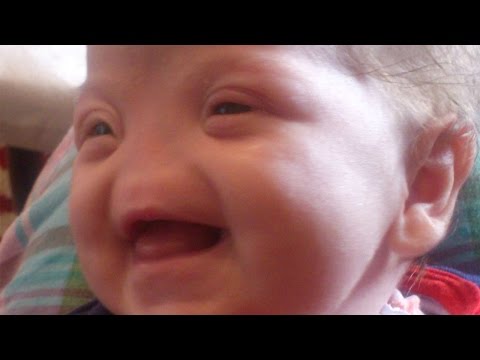 WATCH: Meet the Adorable Baby Girl Born with No Nose