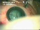 Hypermature cataract Phaco, Trypan Blue by Dr. Sudhalkar