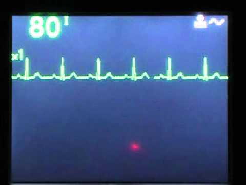 how to treat non sustained v tach