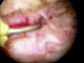 Hysteroscopic incision of uterine septum