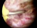 Hysteroscopic incision of uterine septum