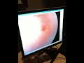 Retinal Eye Exam!