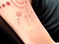 scarification