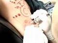 scarification