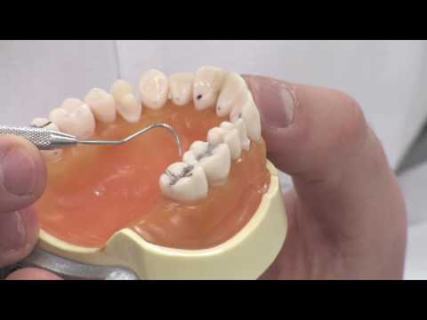 how to fix tooth decay