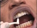 Birkdale Dental Centre Lumineers