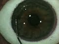 Chirurgie des yeux au laser