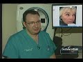 ArteFill Los Angeles - First Permanent wrinkle filler