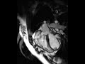 Cardiac MRI - Tetralogy of Fallot