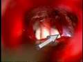 Trigeminal Neuralgia Part II