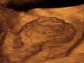 Ca vesical