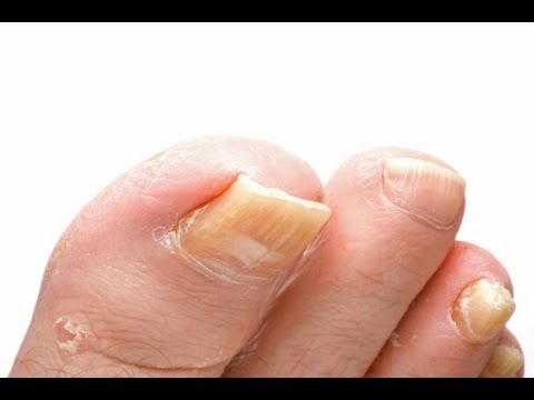 how to treat fungus under toenail