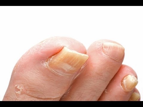 how to treat toenail fungus at home