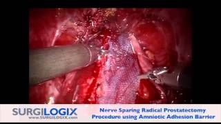 SXBarrier<sup>TM</sup> for Radical Prostatectomy