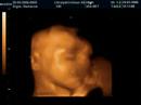 3D Ultrasound of Jacob - 5