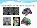 Dr. Andrew Simmons Neuroimaging differences in Down's syndrome