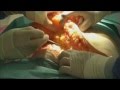 swissestetix Bauchdeckenstraffung - Tummy Tuck
