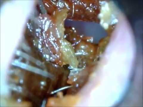 how to get rid ear wax