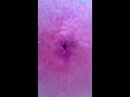 Stevens cyst