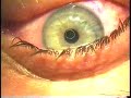 My Lasik