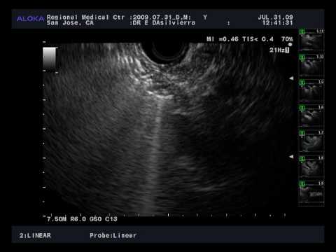 common bile duct and pancreatic duct. ONLY the Common Bile Duct