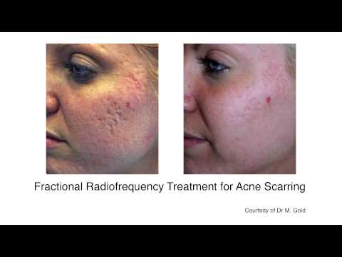 how to treat baby acne uk